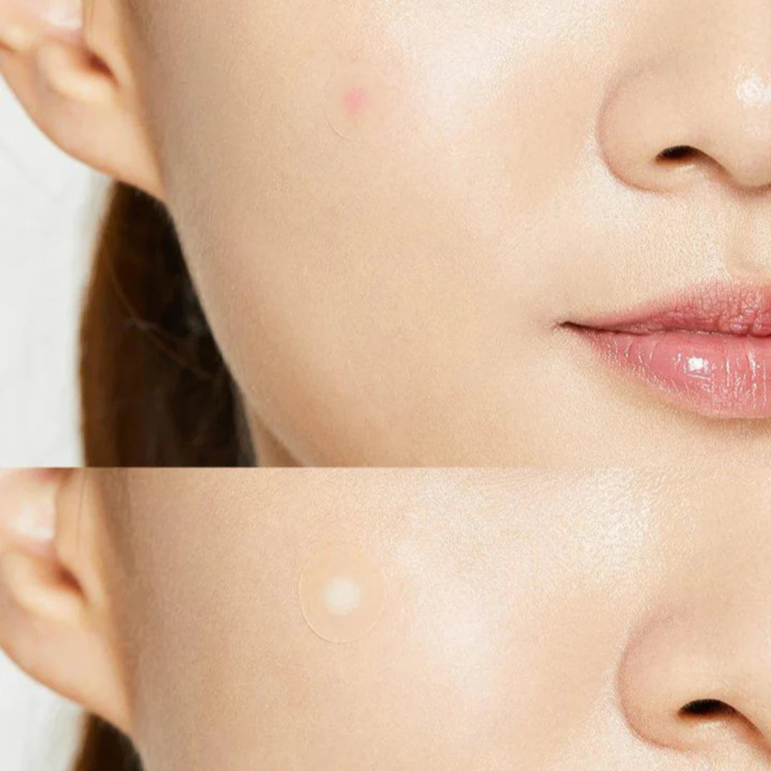 COSRX- Acne Pimple Master Patch